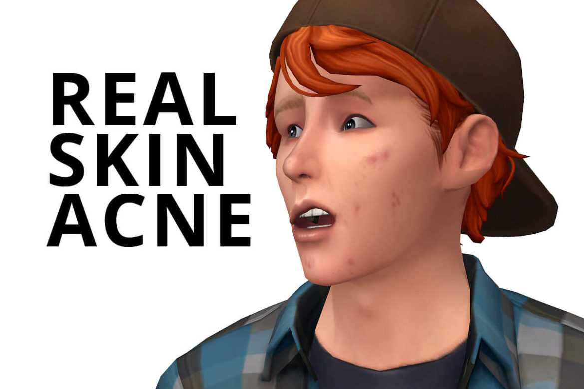 real skin acne skindetail acne